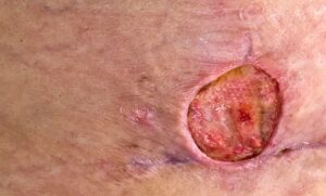 A burulli ulcer presentation on the skin